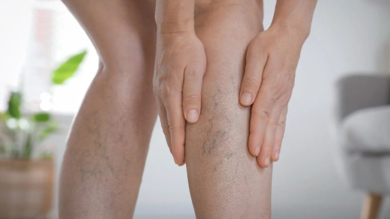 Safe Vein Treatment Options for Clear, Healthy Legs